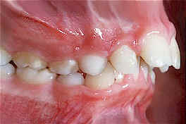 Protrusion example image.