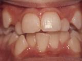 Crowding case example before treatment.