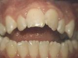 Open bite case example before treatment.