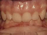 Deep overbite case example before treatment.