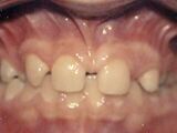 Missing lateral incisors case example before treatment.