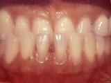 Underbite case example before treatment.