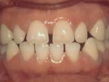 Spacing case example before treatment.