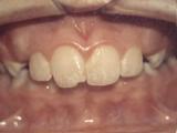 Overbite with protruding incisors case example before treatment.