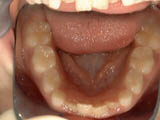 Non-braces treatment case example before treatment.