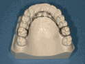 Fixed orthodontic habit appliance used to discourage thumb or finger habits.